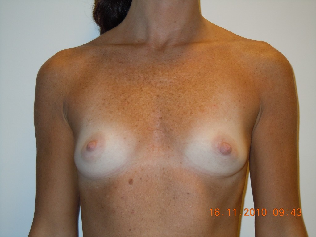 Una paziente prima dell'intervento al seno